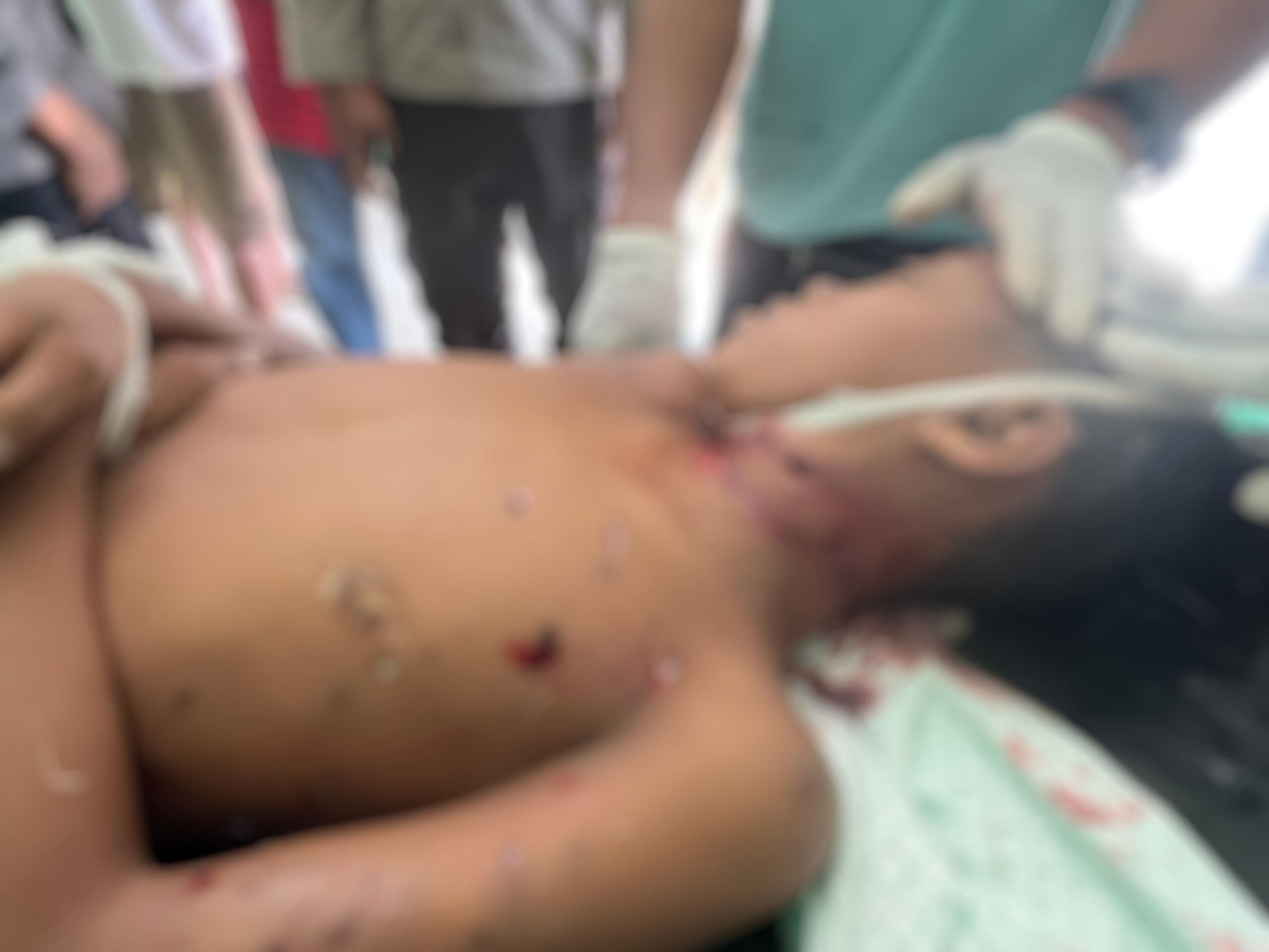 Foto-Bocah-Korban-Anjing-Liar